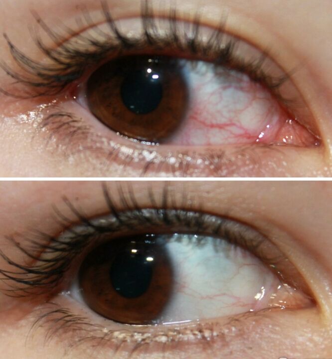 Ocuvit fonctionne très rapidement