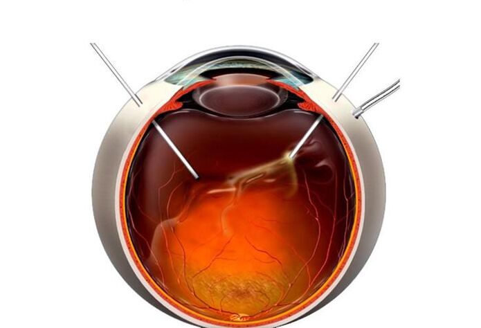 Vitrectomie - une opération pour restaurer la vision